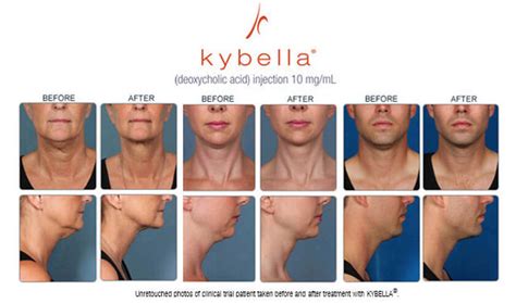 kybella liverpool|Kybella: Uses, Taking, Side Effects, Warnings .